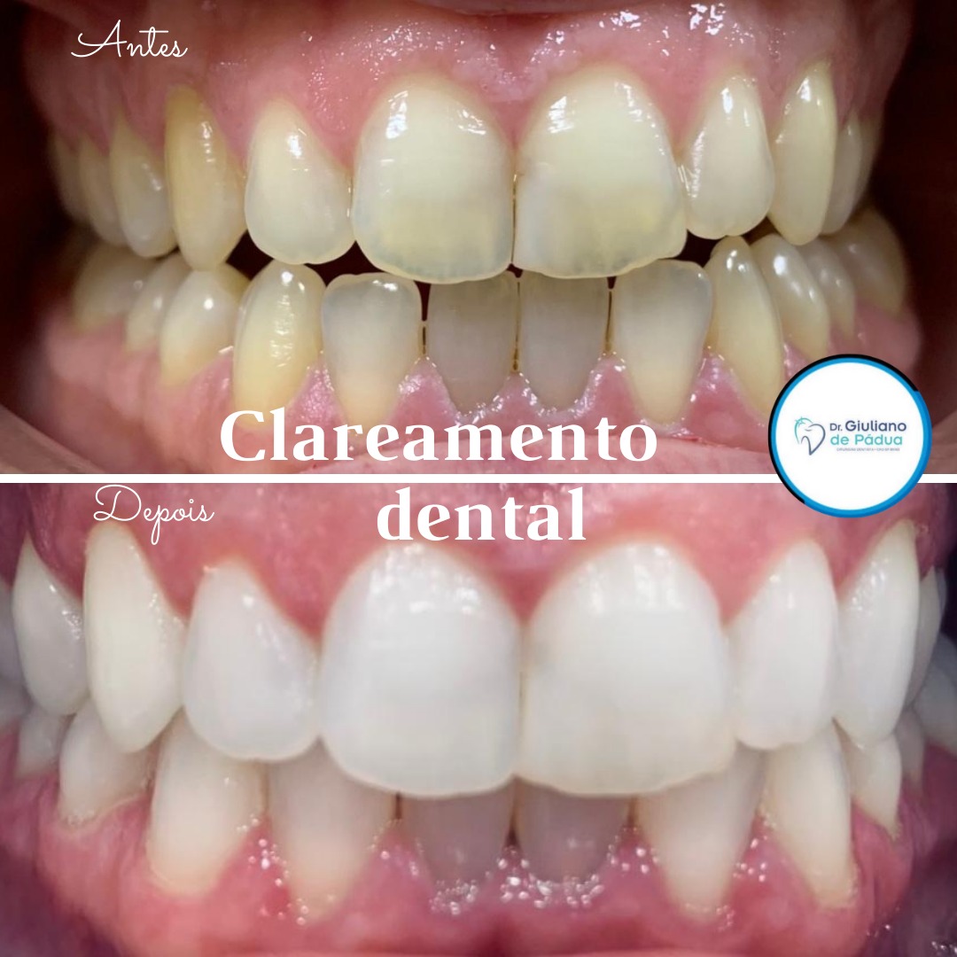Clareamento - Dr. Giuliano de Pádua