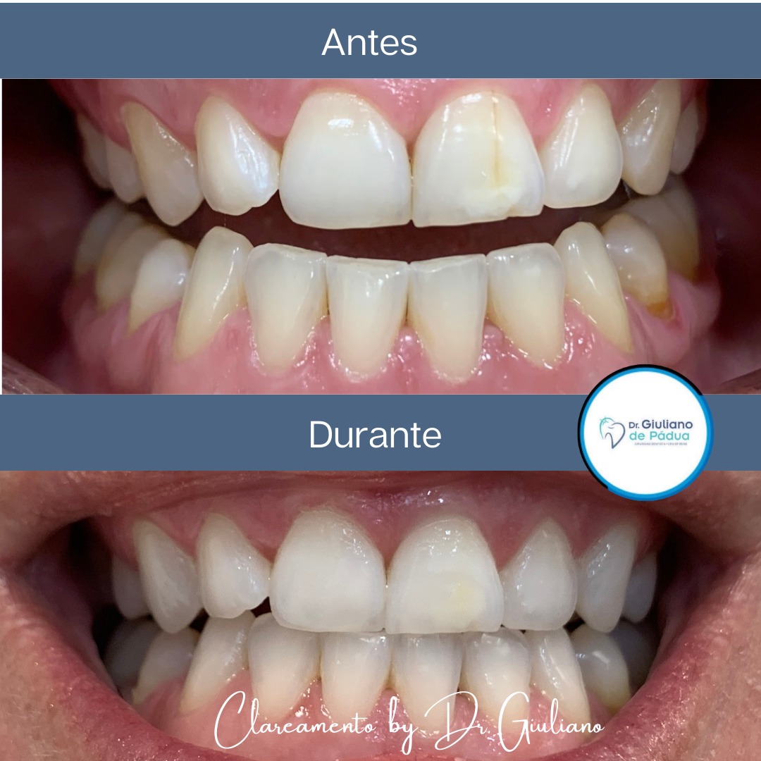 Clareamento Dental — Dr. Giuliano de Pádua