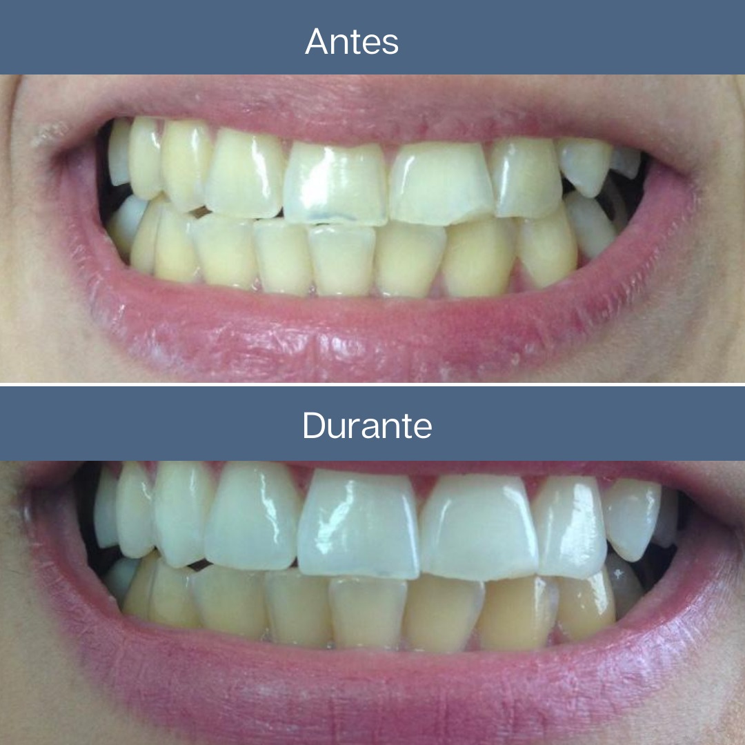 Clareamento Dental — Dr. Giuliano de Pádua