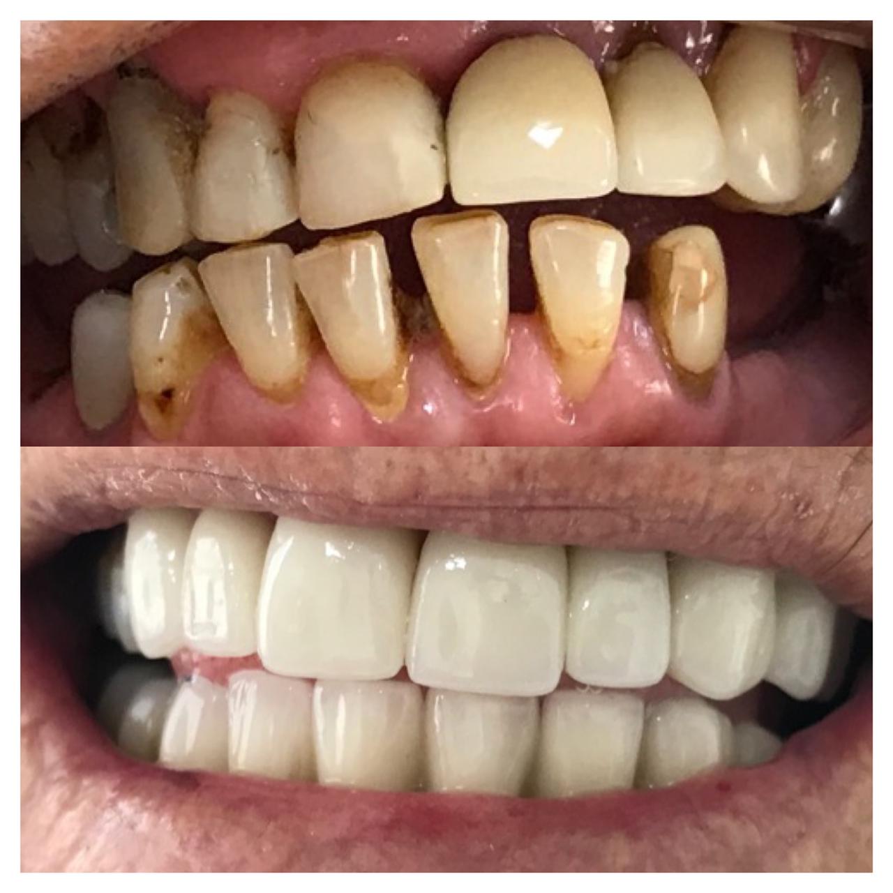 Implantes — Dr. Giuliano de Pádua