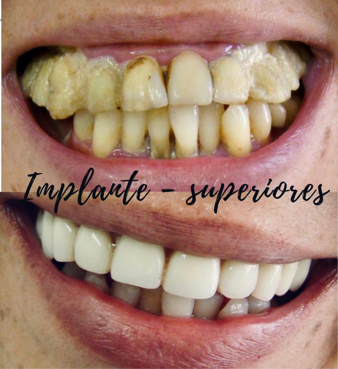 Implantes — Dr. Giuliano de Pádua