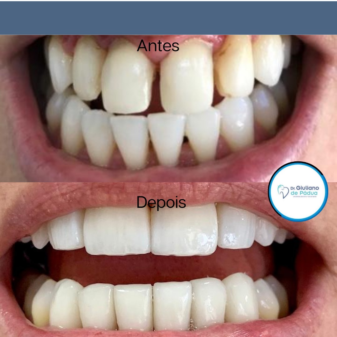Lentes de Contato e Facetas — Dr. Giuliano de Pádua
