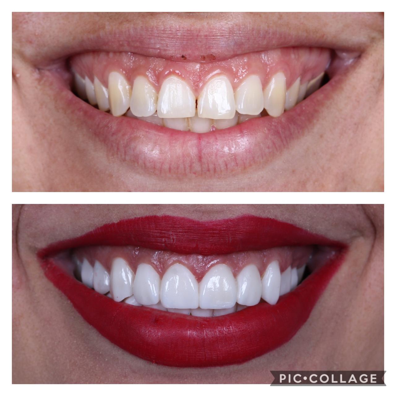 Lentes de Contato e Facetas — Dr. Giuliano de Pádua