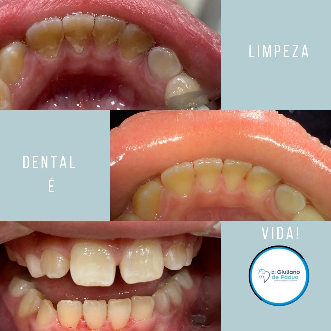 Tratamento Periodontal — Dr. Giuliano de Pádua